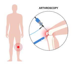 Arthroscopy Key hole surgery