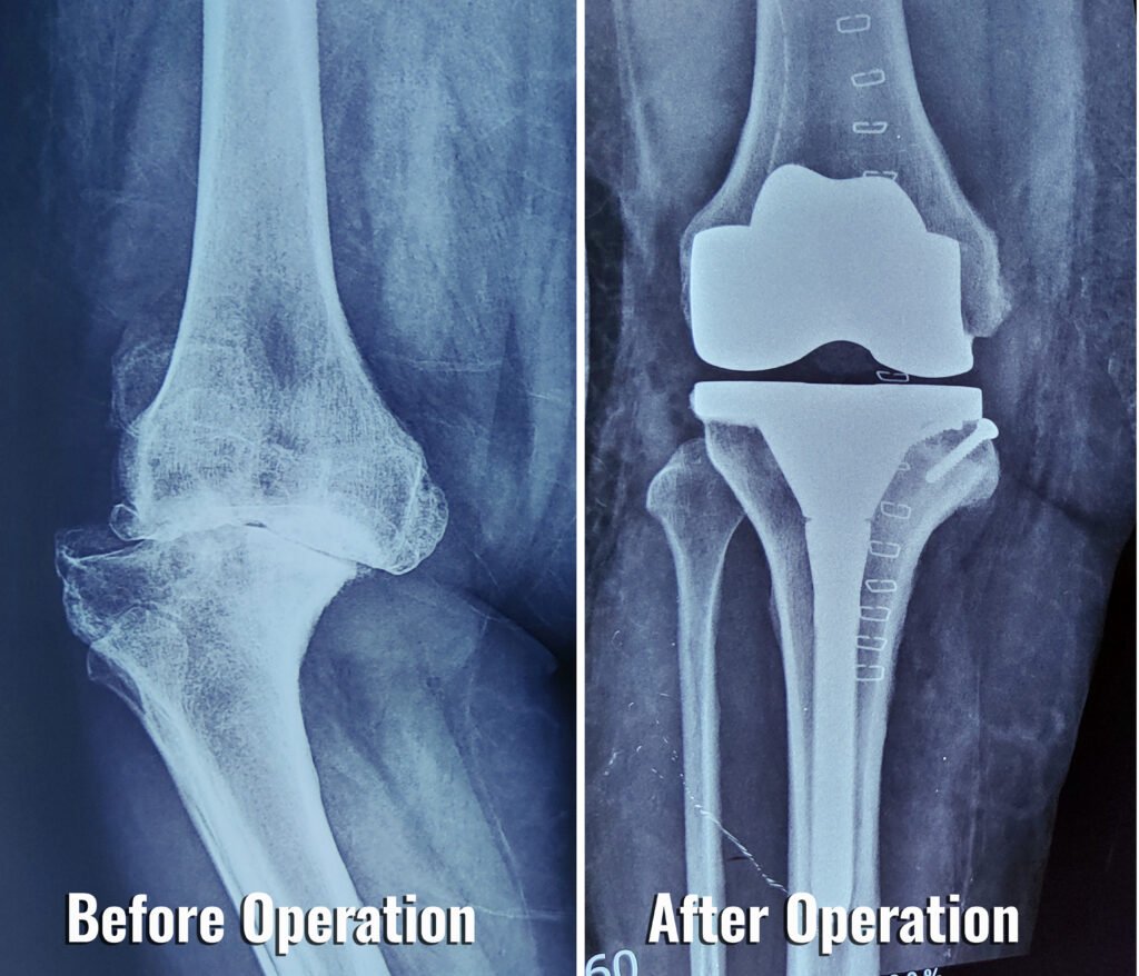 Knee replacement xray